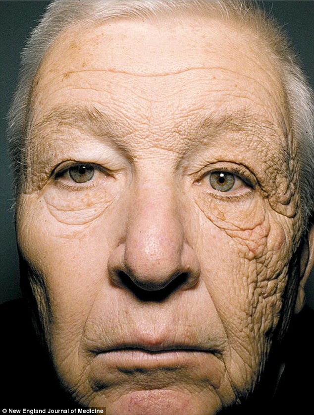 Zonveroudering linkerhelft gezicht 69-jarige vrachtwagenchaffeur