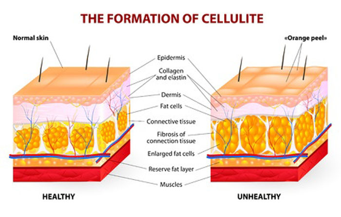 Formatie en anatomie van cellulite