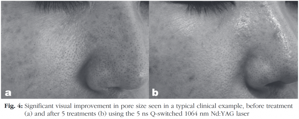 Grove poriën voor en na behandeling met Nd:YAG laser. Bron: Roh et al., 2011.