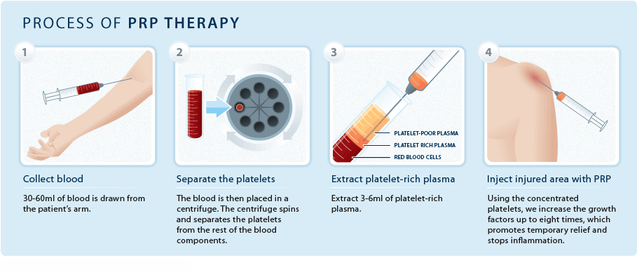 Platelet_Rich_Plasma_proces_PRP-Therapy