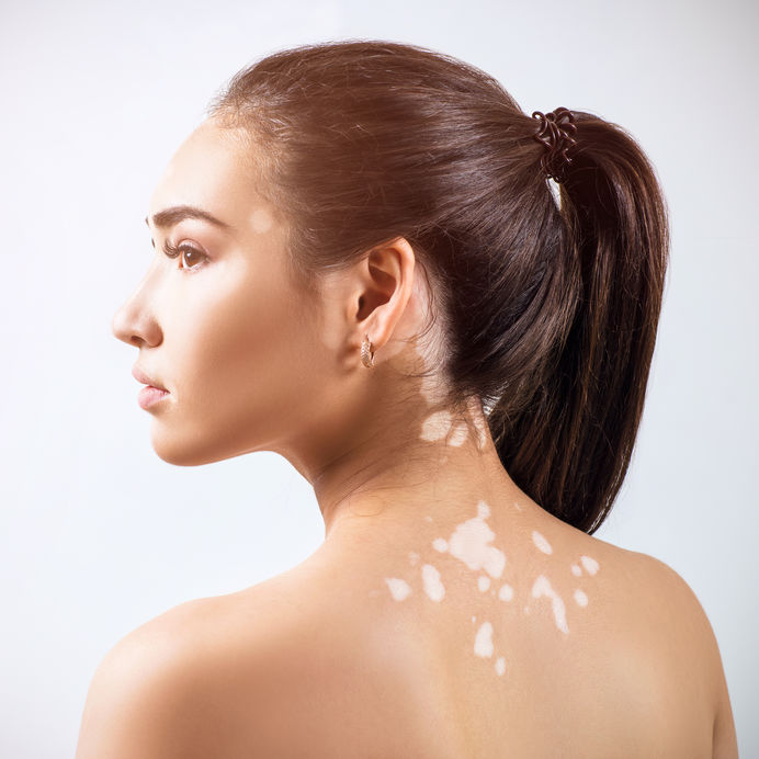 Huidproblemen (vitiligo)