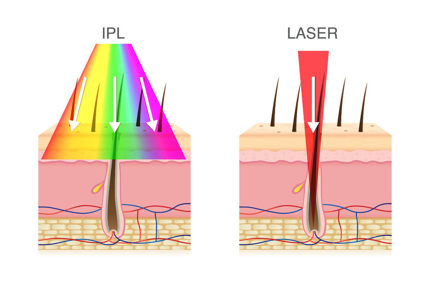 IPL versus laser