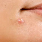 De ins & outs van acne. Deel 2: Wat is acne en welke vormen van acne zijn er?